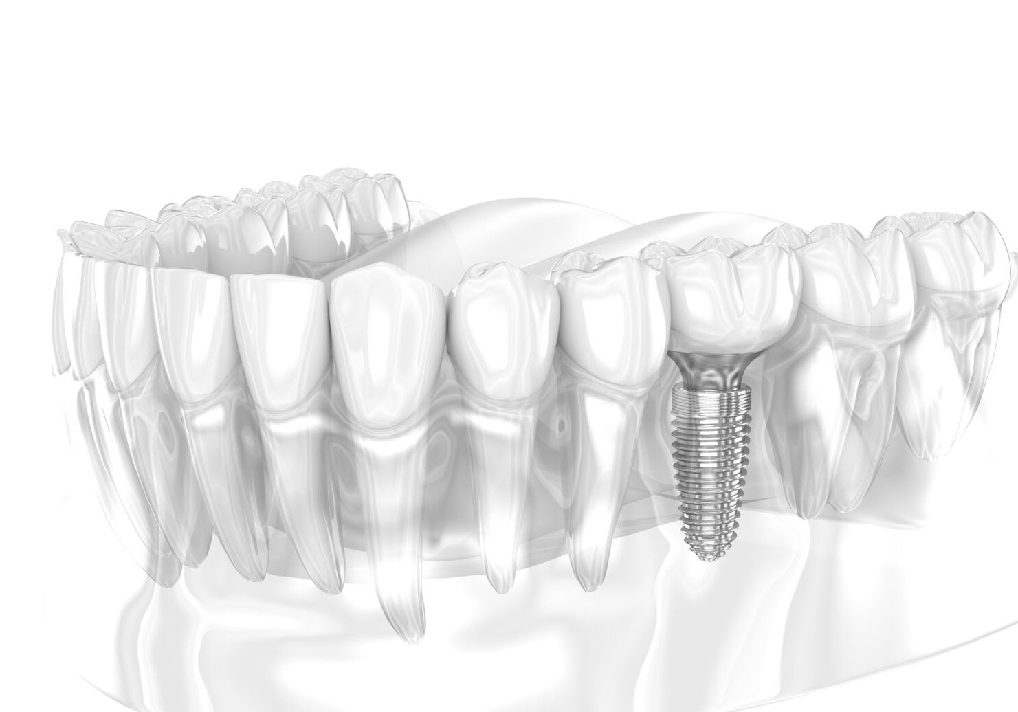 Dental Implant and ceramic crown. 3D illustration of human teeth